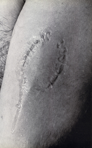 След от укуса Вито Аккончи. Боди-арт акция. 1970. Неизвестный фотограф.